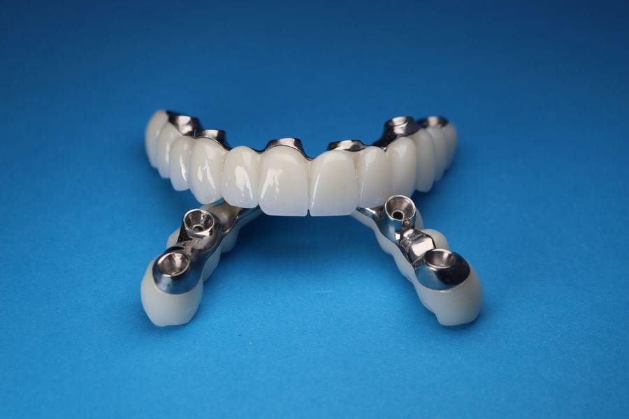 Full arch implant bridge with titanium connectors on a blue background