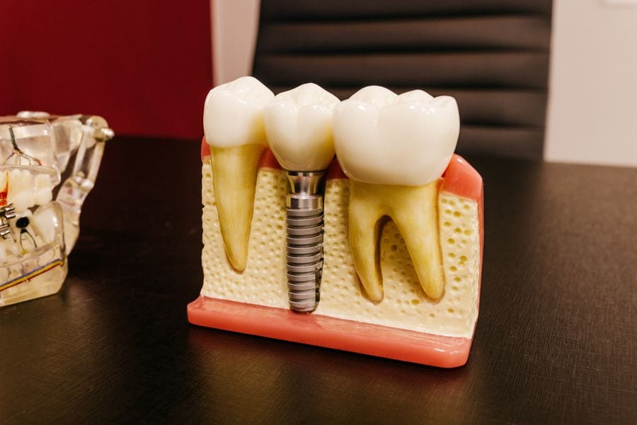 Cutaway model showing a dental implant beneath a crown